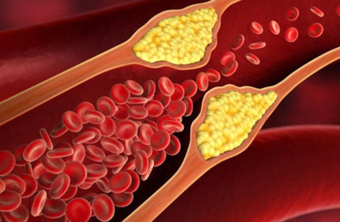 Aterosclerosi colesterolo HDL