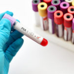 Un nuovo esame del sangue per rilevare il cancro alla prostata
