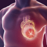 Potenziale nuovo farmaco potrà prevenire infarti