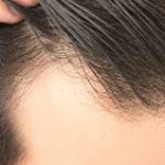 Novità per cure alopecia androgenetica 2020