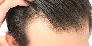 Alopecia androgenetica cure