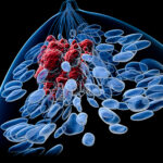 Tumore al seno inibitori LMTK3