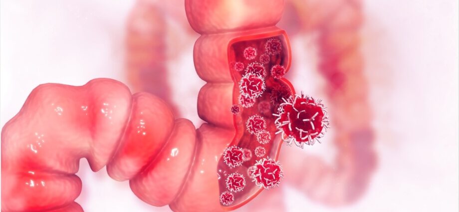 Tumore colon nuove cure con virus oncolitico